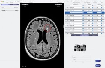 Swiss Made Software: KI-Einsatz in der Radiologie